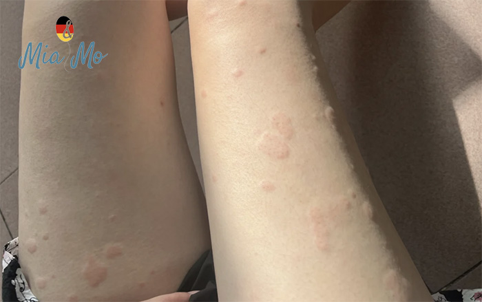 bị mề đay có nên xông hơi